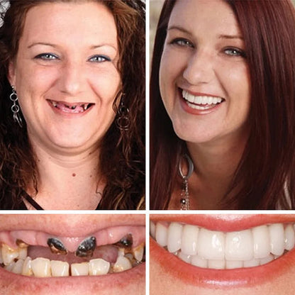⚡ 🌎Ends Today: 70% OFF! ⏰ Medical Full Denture with Strong Suctiond