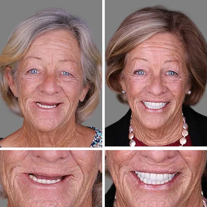 🏆Ends Today: 75% OFF! ⏰DarkFairy™ Medical Full Denture with Strong Suctiond Custom-Fit Full Functional Dentures🦷