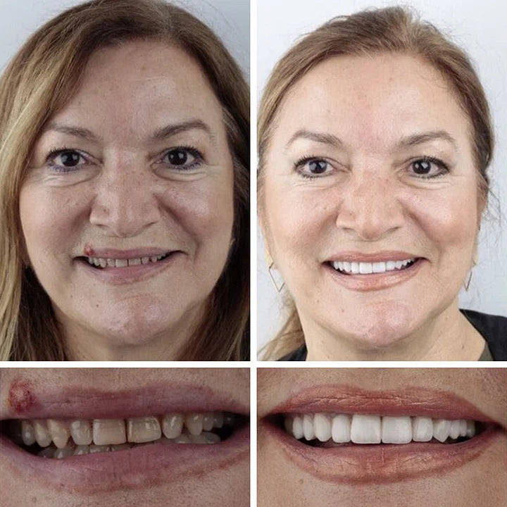 🏆Ends Today: 75% OFF! ⏰DarkFairy™ Medical Full Denture with Strong Suctiond Custom-Fit Full Functional Dentures🦷
