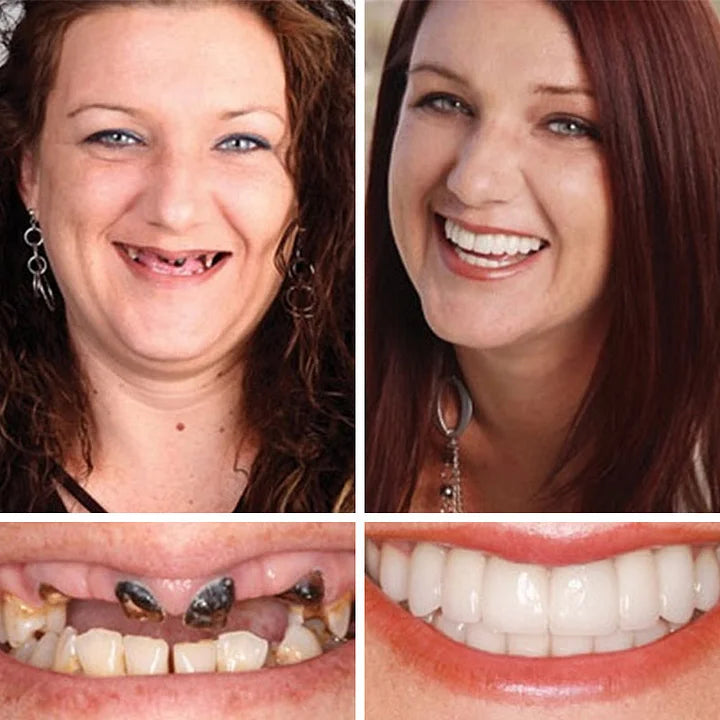 🏆Ends Today: 75% OFF! ⏰DarkFairy™ Medical Full Denture with Strong Suctiond Custom-Fit Full Functional Dentures🦷