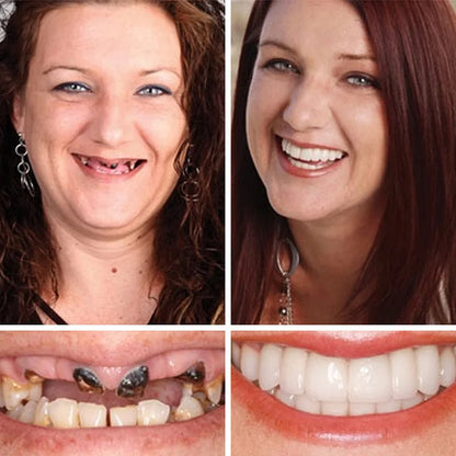 🏆Ends Today: 75% OFF! ⏰DarkFairy™ Medical Full Denture with Strong Suctiond Custom-Fit Full Functional Dentures🦷