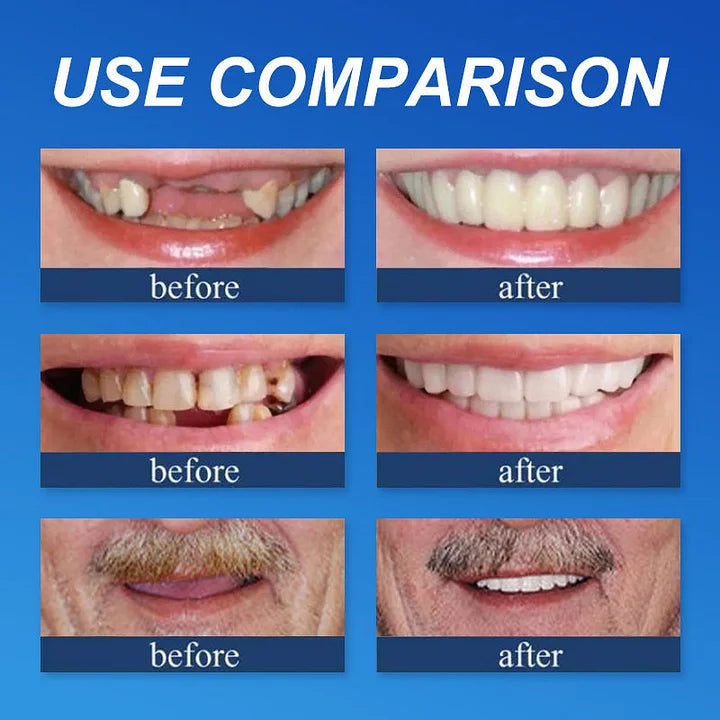 🏆Ends Today: 75% OFF! ⏰DarkFairy™ Medical Full Denture with Strong Suctiond Custom-Fit Full Functional Dentures🦷